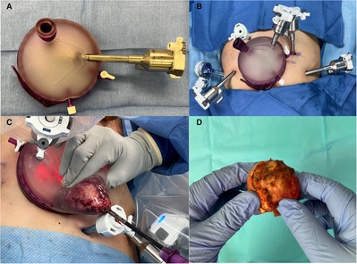 Overskyet forsvinde Klassificer Frontiers | Robot-assisted radical prostatectomy: Advancements in surgical  technique and perioperative care