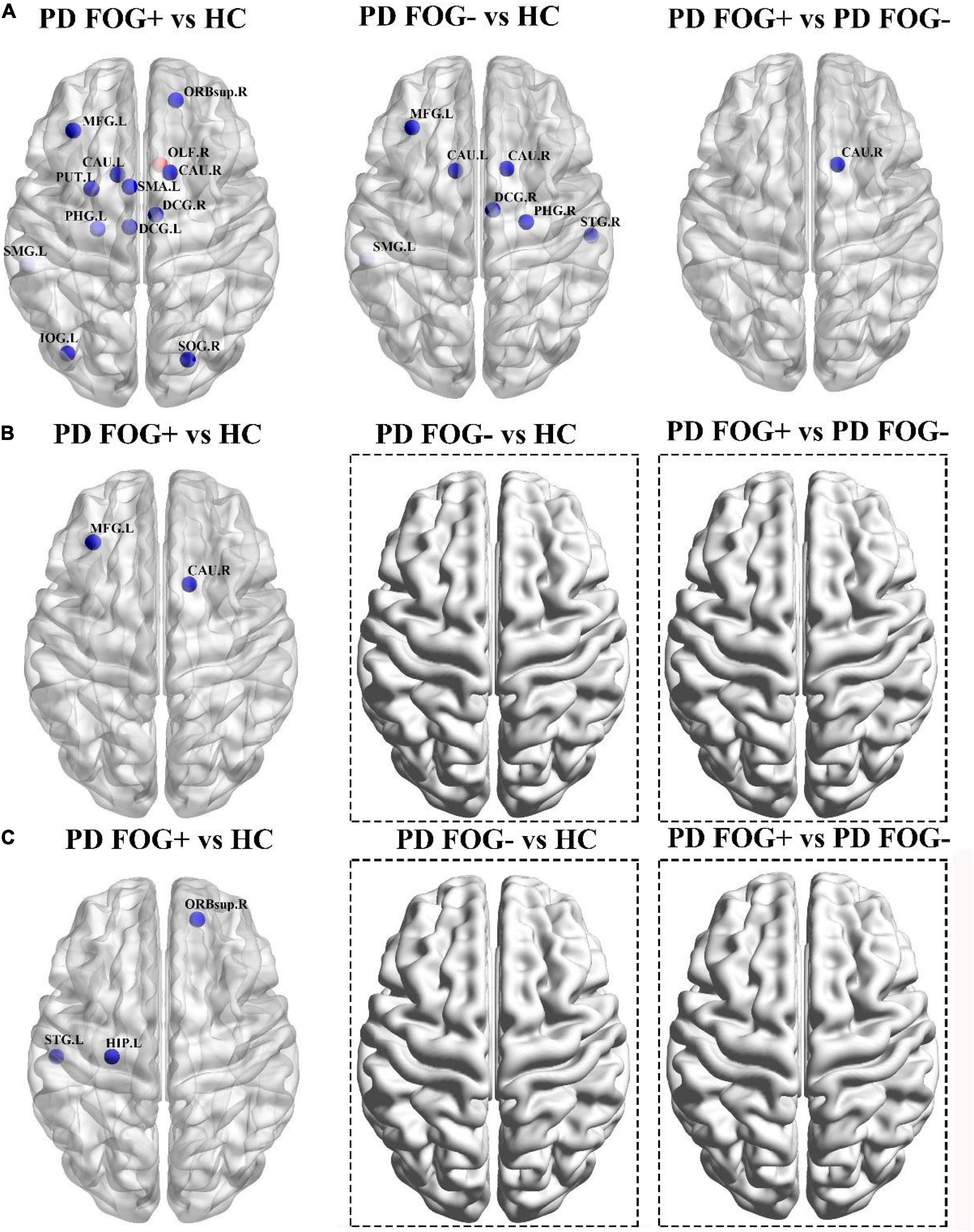 Frontiers  Structural Brain Network Abnormalities in Parkinson's