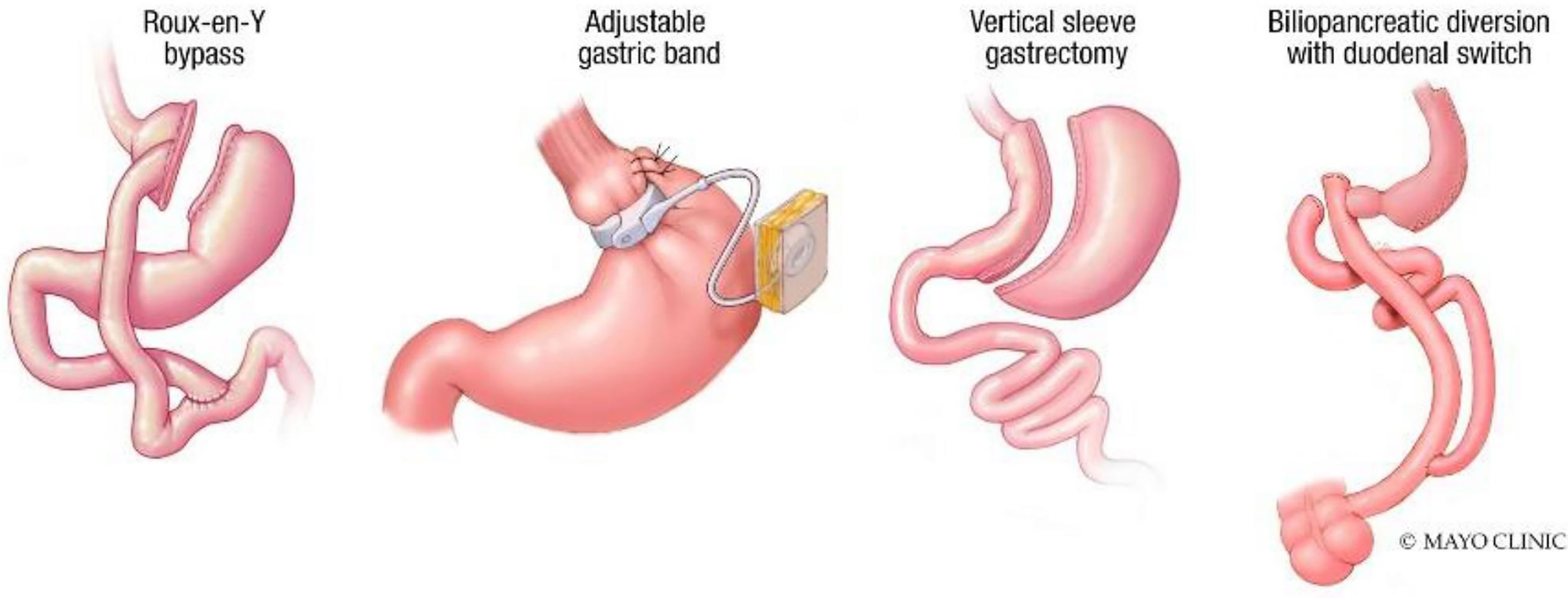 Endoscopic Options for Weight Loss