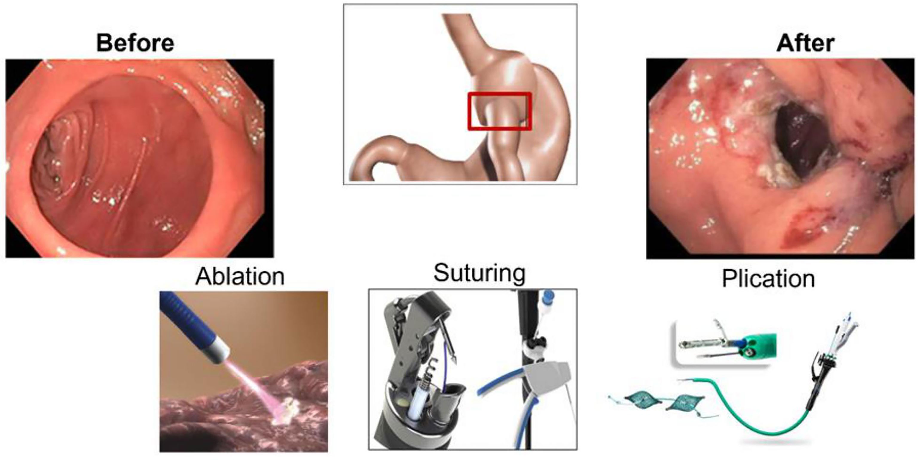 Endoscopic Options for Weight Loss