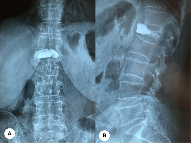 Treating Compression Fracture with Kyphoplasty vs. Bracing