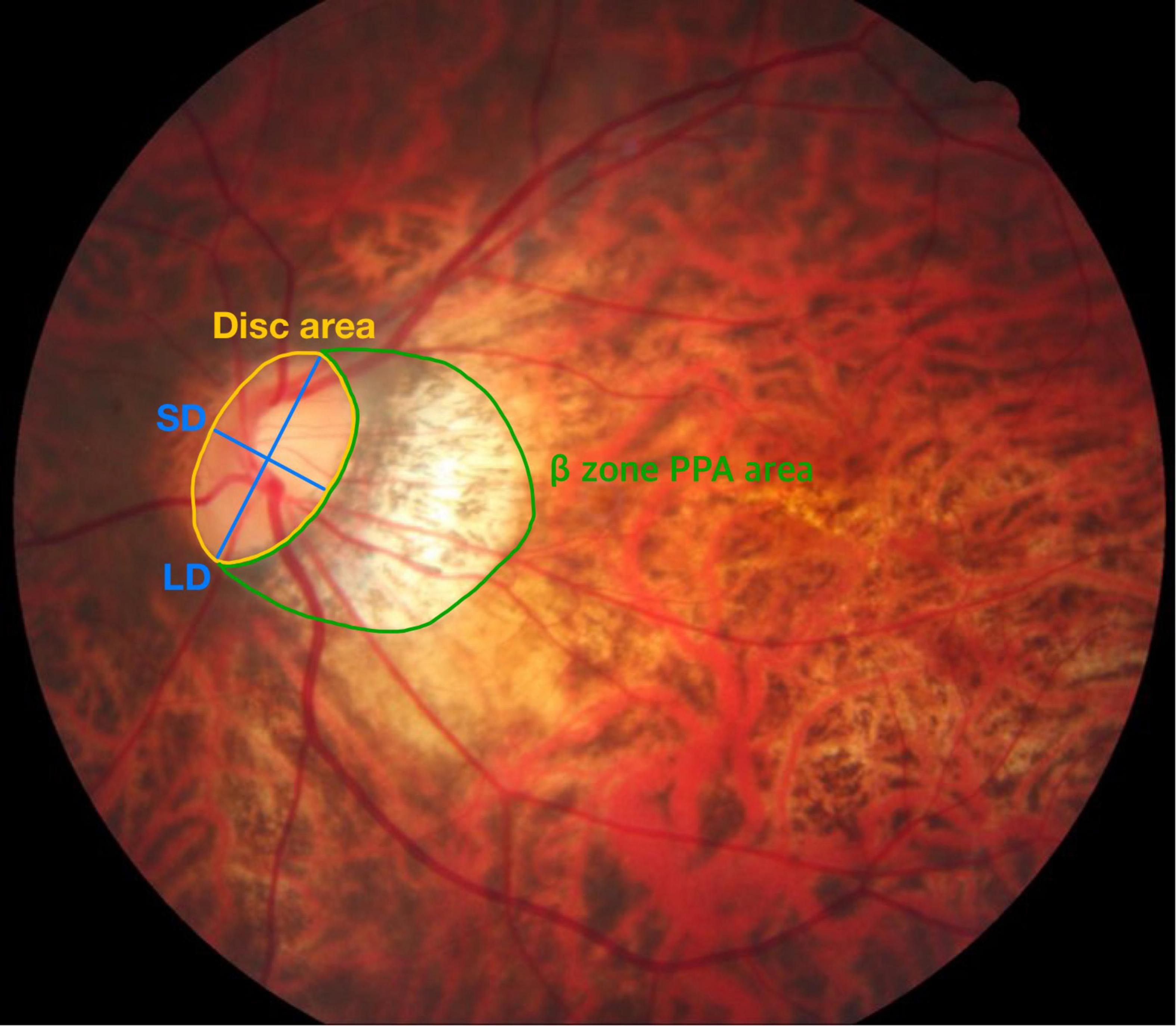 Choroidal Crescent Optic Nerve