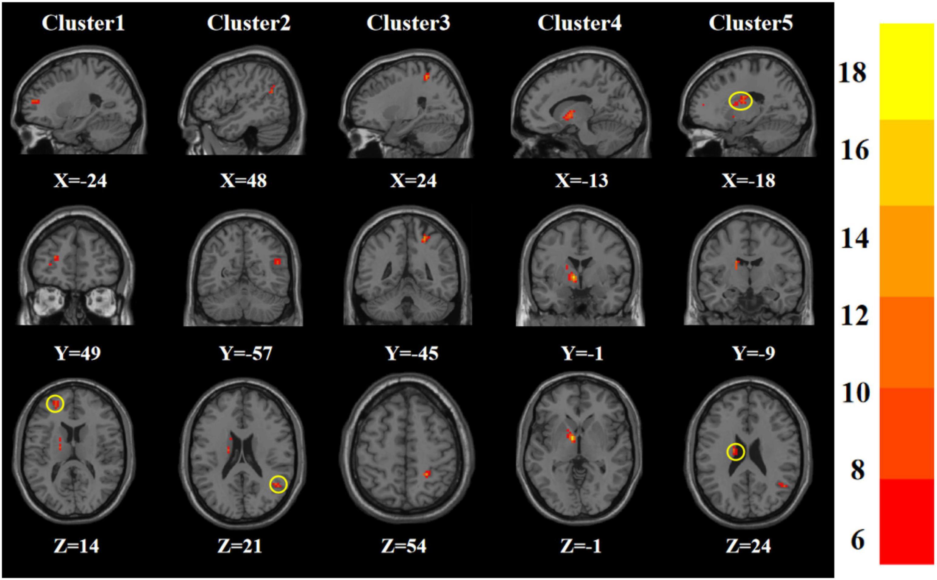 Frontiers  Neural activity in adults with major depressive disorder  differs from that in healthy individuals: A resting-state functional  magnetic resonance imaging study