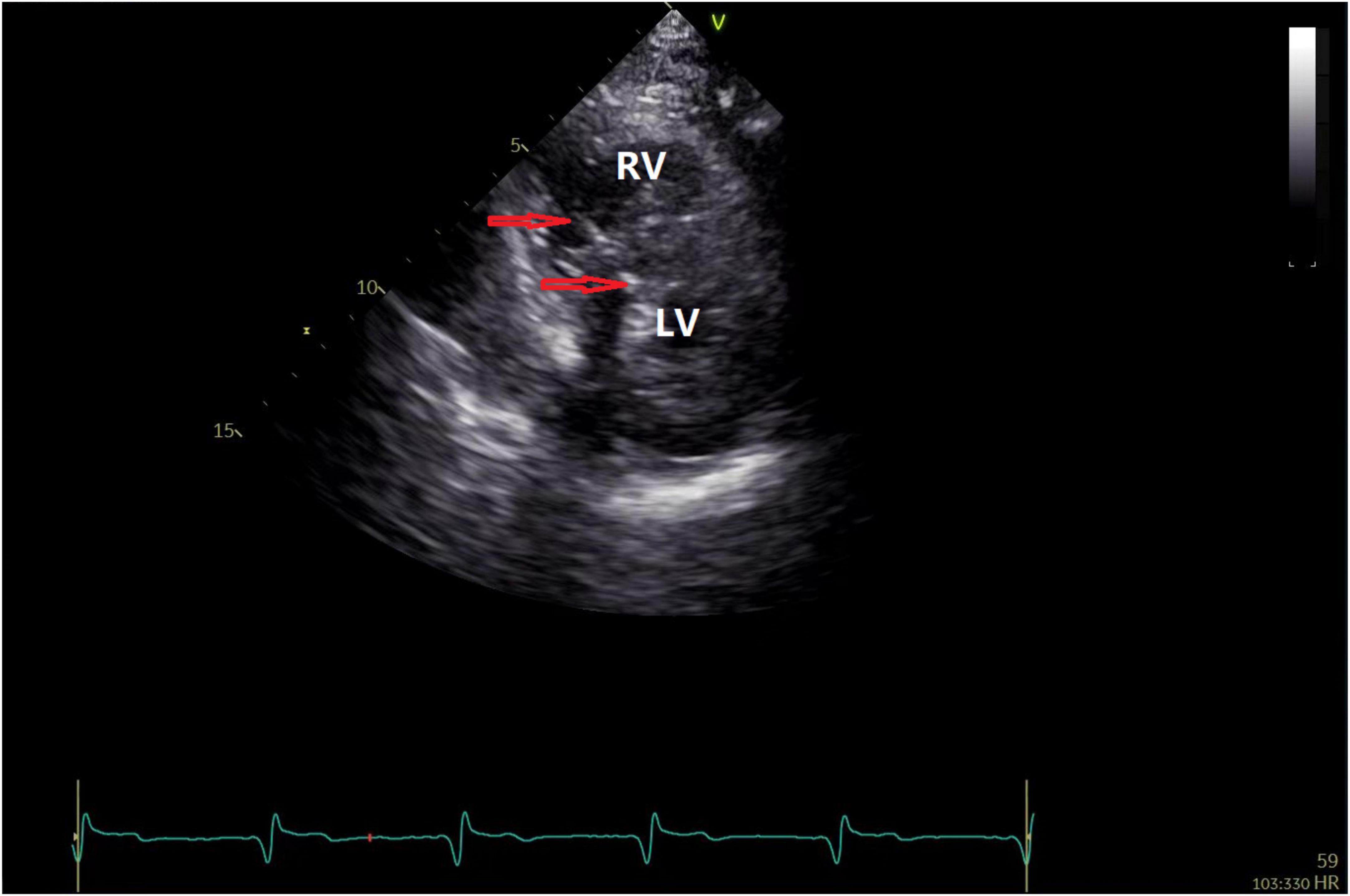 Speckle tracking strain and ECG heterogeneity correlate in transcatheter  aortic valve replacement-induced left bundle branch blocks and right  ventricular paced rhythms