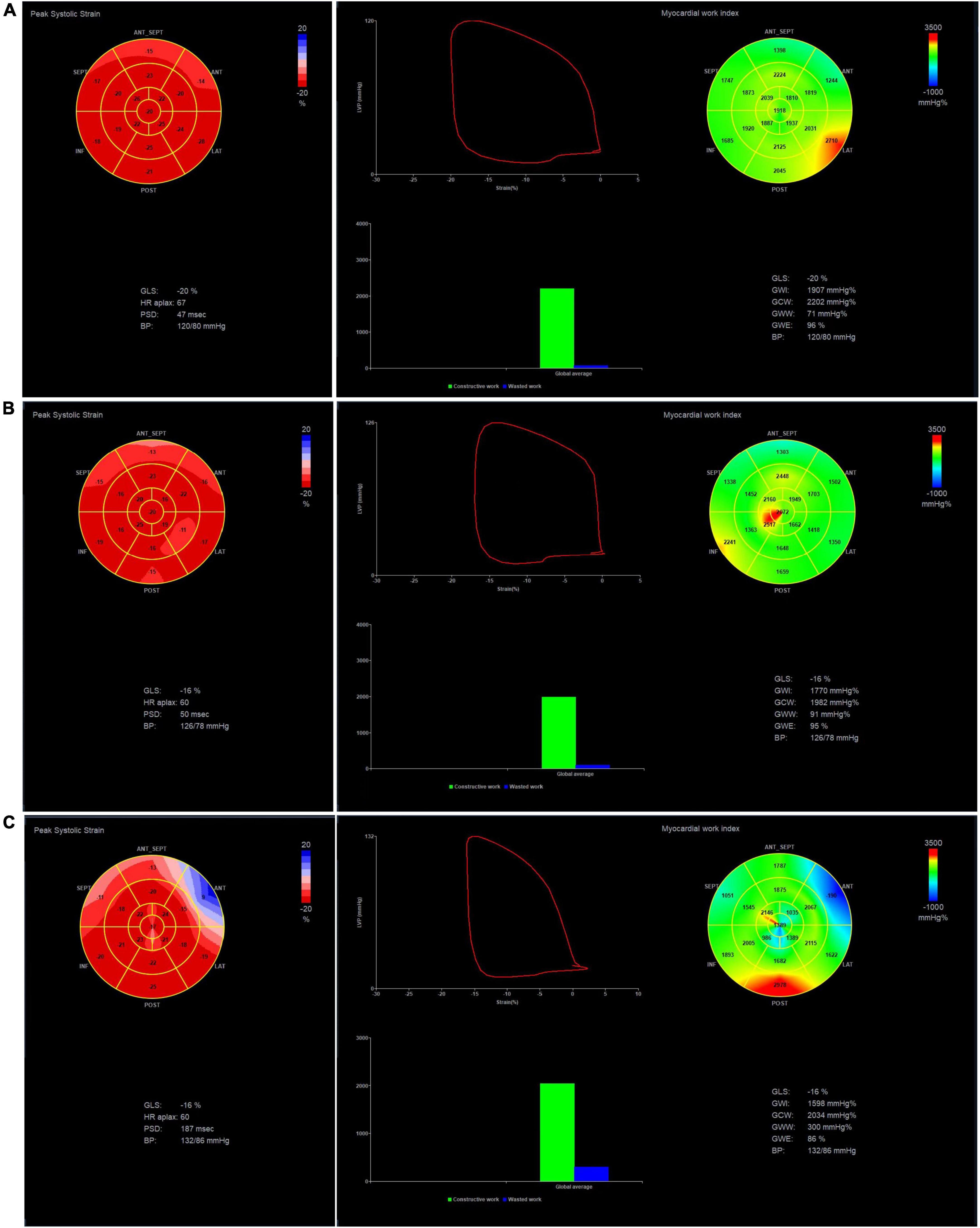 Speckle tracking strain and ECG heterogeneity correlate in transcatheter  aortic valve replacement-induced left bundle branch blocks and right  ventricular paced rhythms