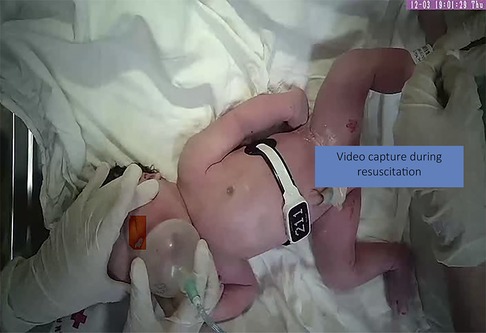 Frontiers | Neonatal resuscitation monitoring: A low-cost video recording setup for quality improvement in the delivery room at the resuscitation table Frontiers | Neonatal resuscitation monitoring: A low-cost video recording setup for quality improvement in the delivery room at the resuscitation table