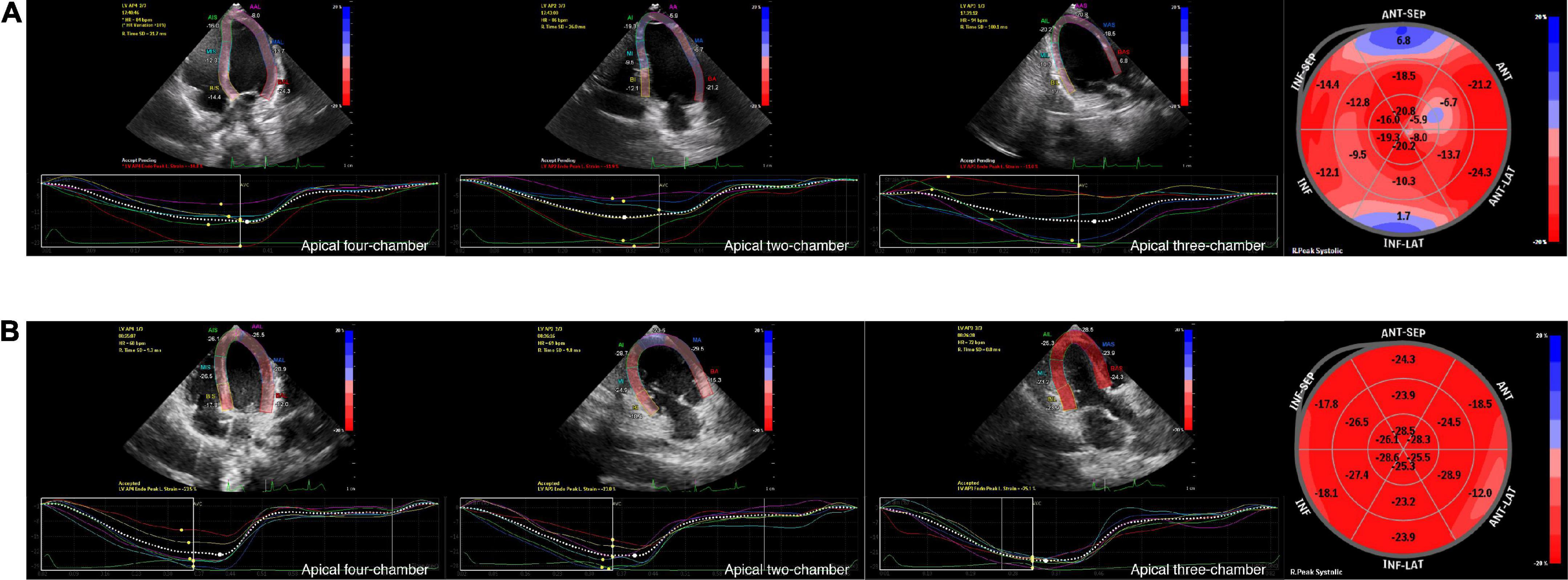 Reference values for two-dimensional myocardial strain echocardiography of  the left ventricle in healthy children, Cardiology in the Young