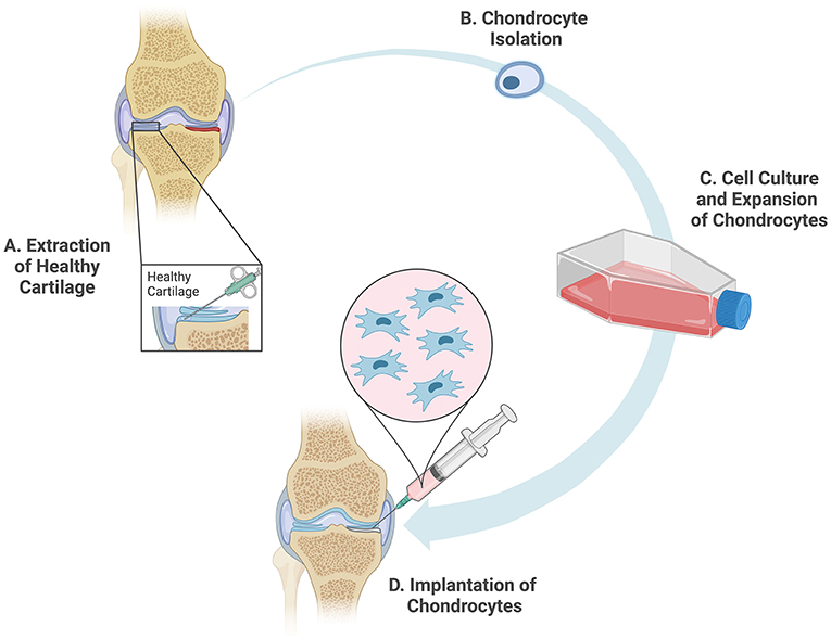 Figure 2 - (A) To perform ACI, surgeons first extract a sample of healthy cartilage from the targeted joint.