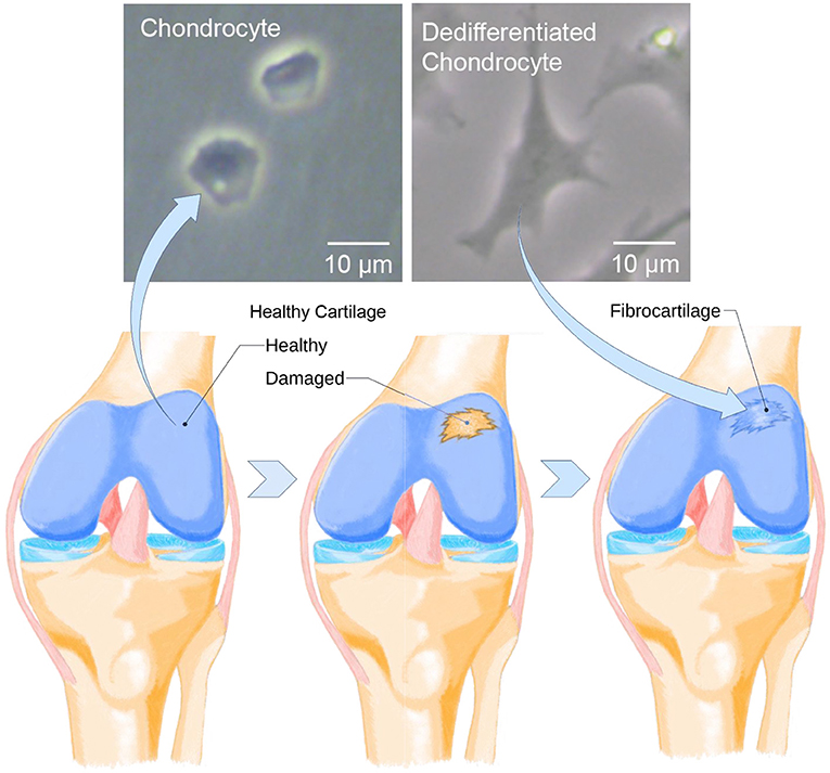Figure 3 - Growing chondrocytes in the lab leads to dedifferentiation.