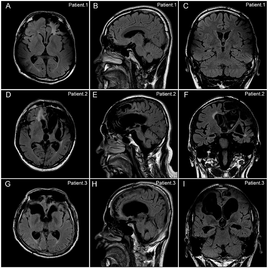 Vagal nerve stimulators? - Questions and Answers ​in MRI