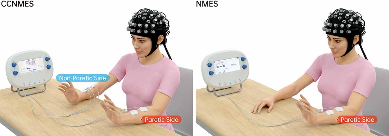 sEMG-triggered NMES unit and electrode placement