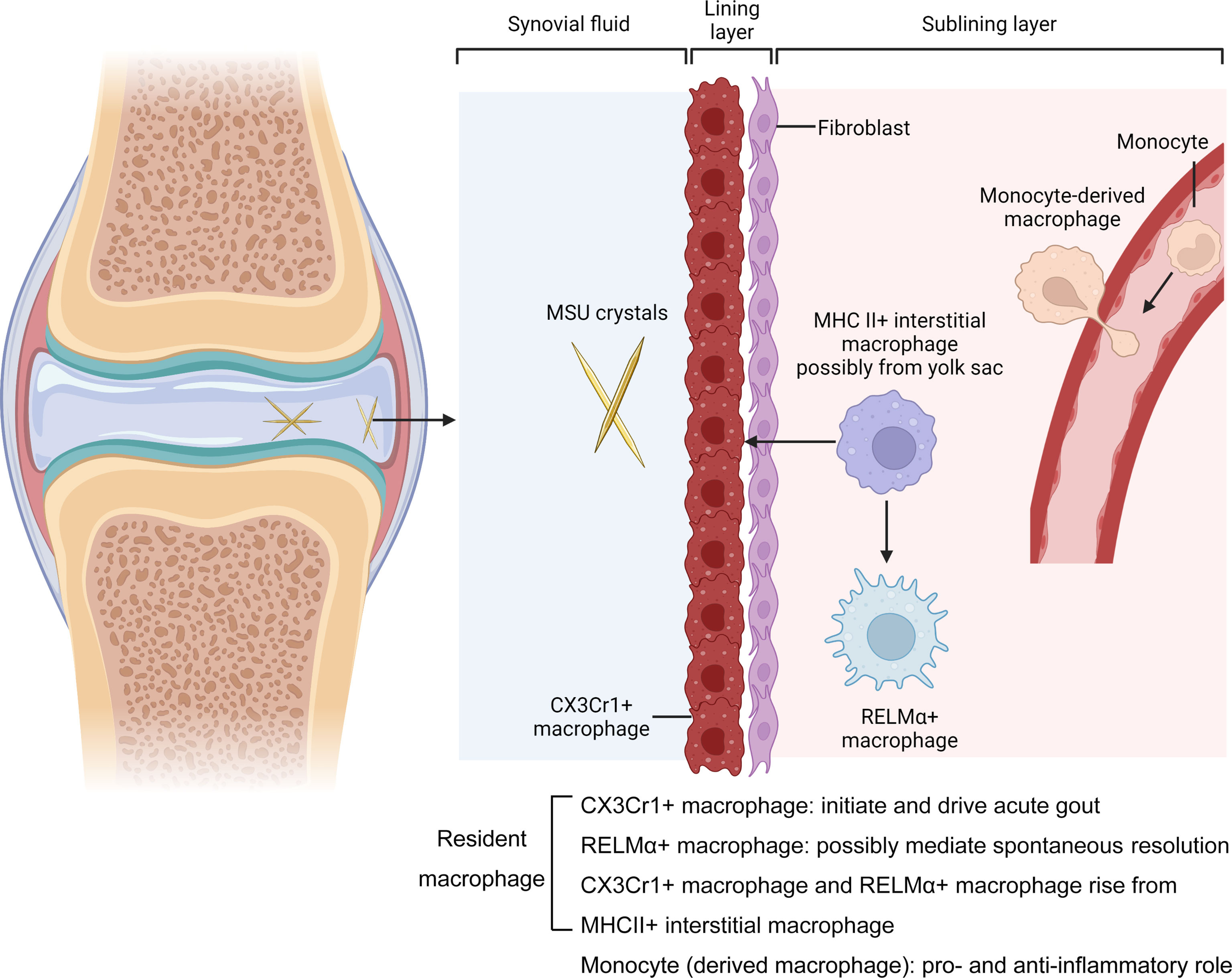 gout vs pseudogout crystals