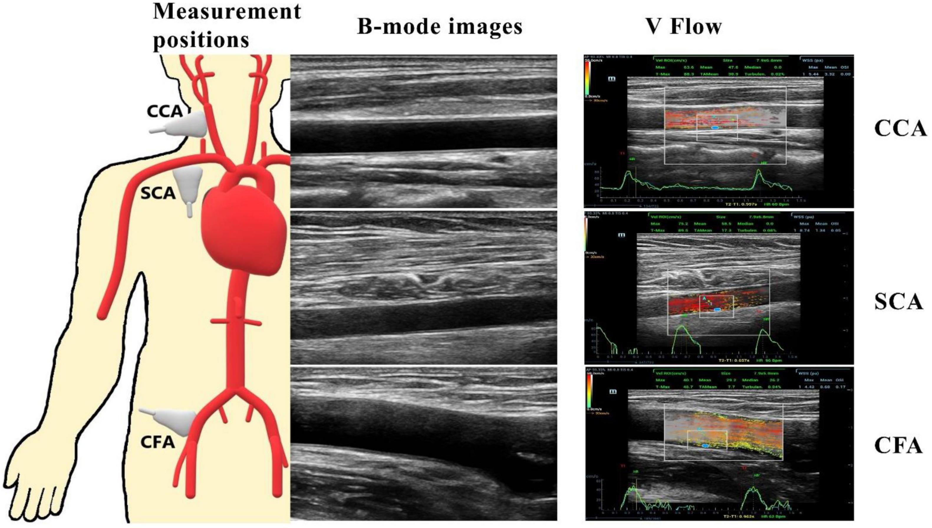 The average radial artery blood flow velocity (vrad.art.mean