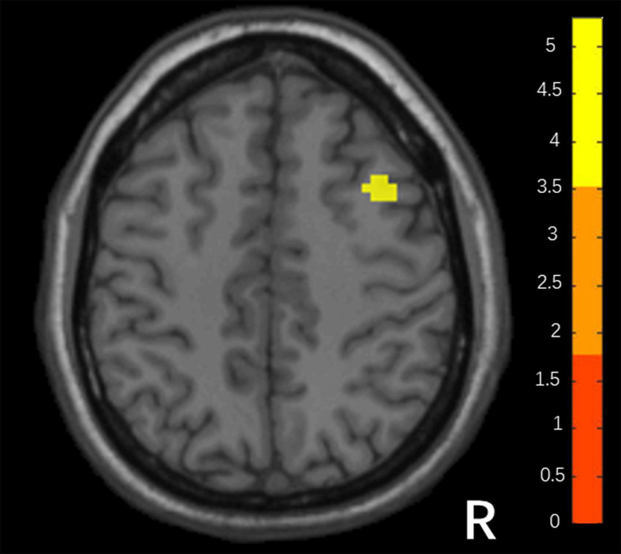 Frontiers  Neural activity in adults with major depressive disorder  differs from that in healthy individuals: A resting-state functional  magnetic resonance imaging study