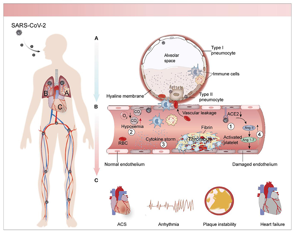 Endothelial cell infection and endotheliitis in COVID-19 - The Lancet