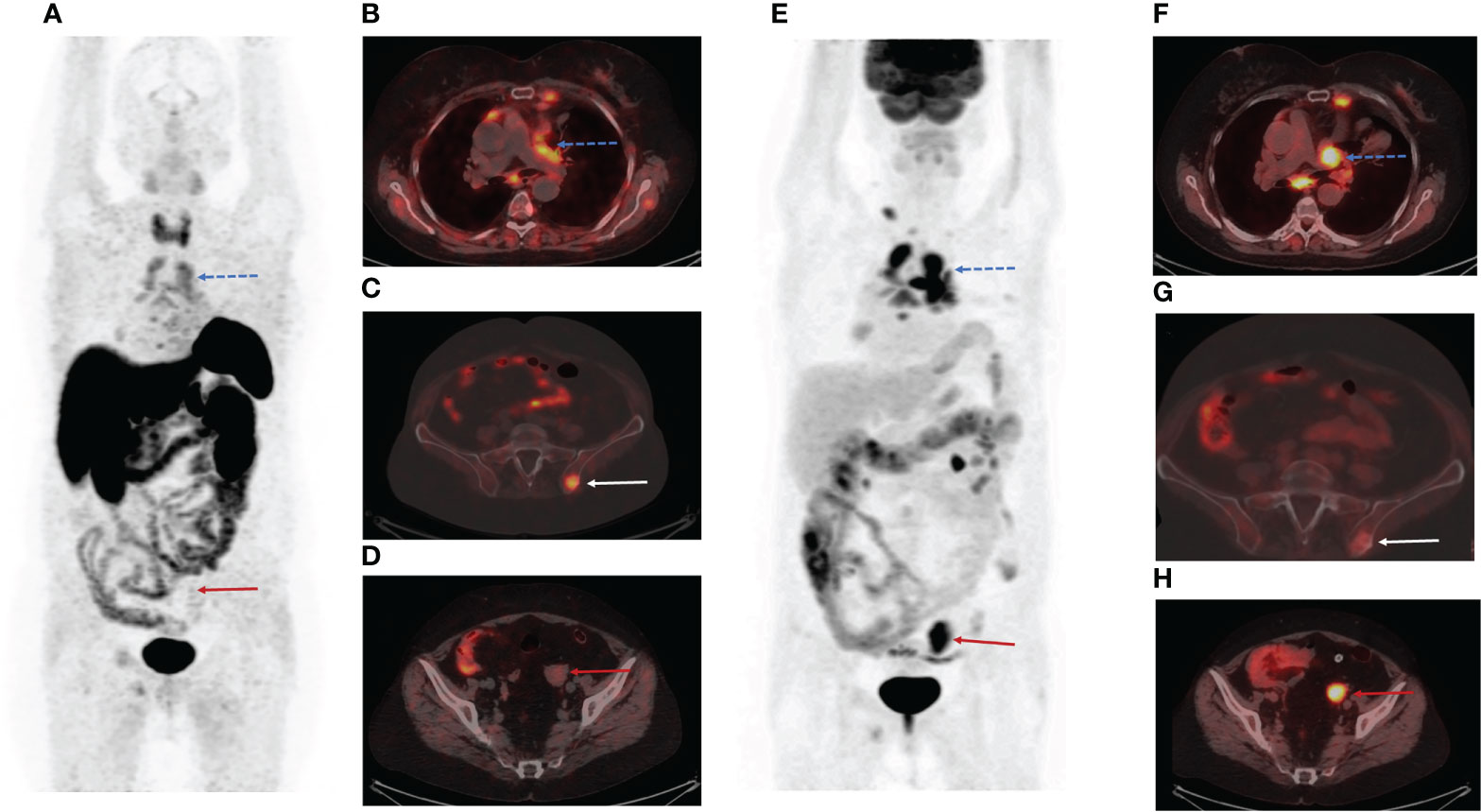 Leveraging Datature Nexus for Tumor and Anomaly Detection in Medical Scans : Part I