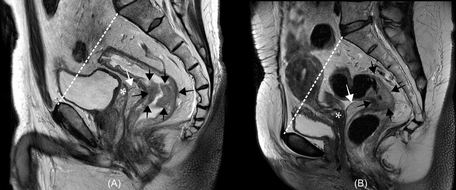 Frontiers Clinical Implication And Management Of Rectal Cancer With frontiers-clinical-implication-and-management-of-rectal-cancer-with