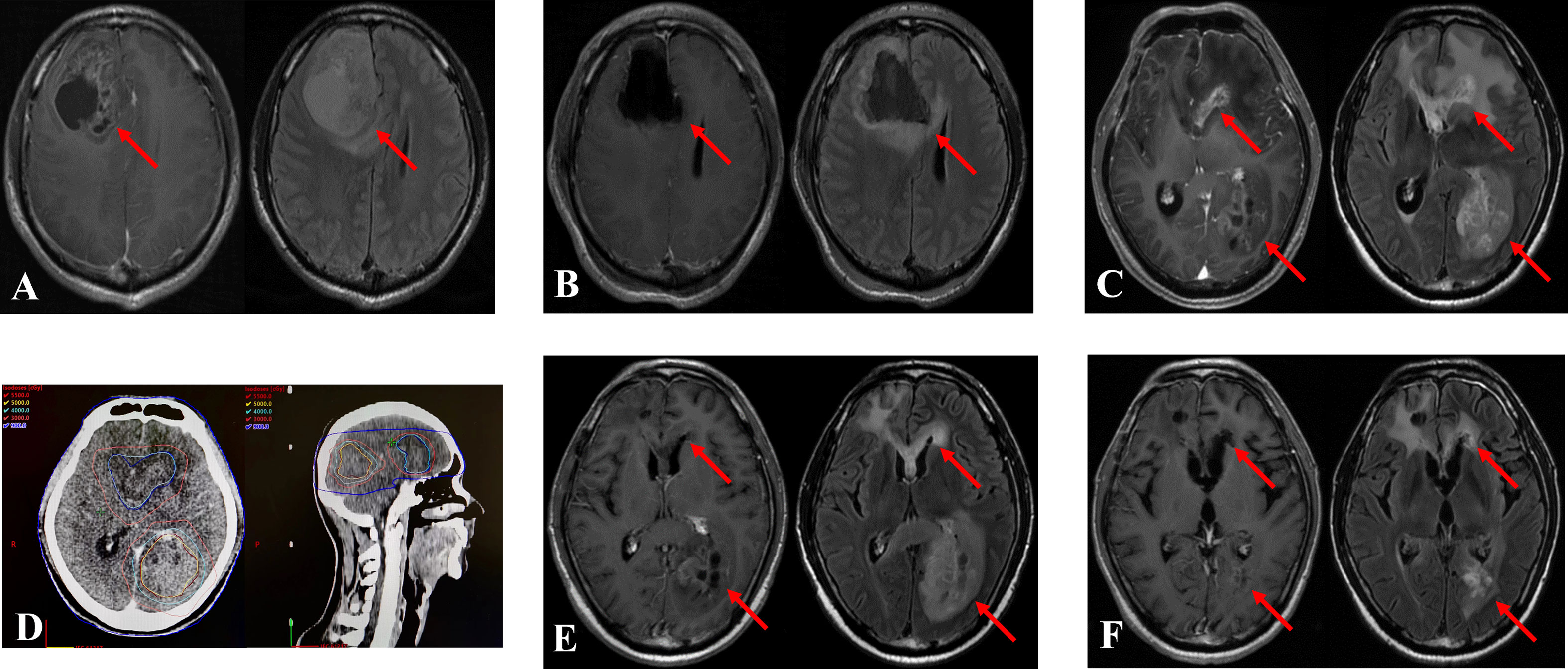 Frontiers | Bevacizumab combined with re-irradiation in recurrent  glioblastoma