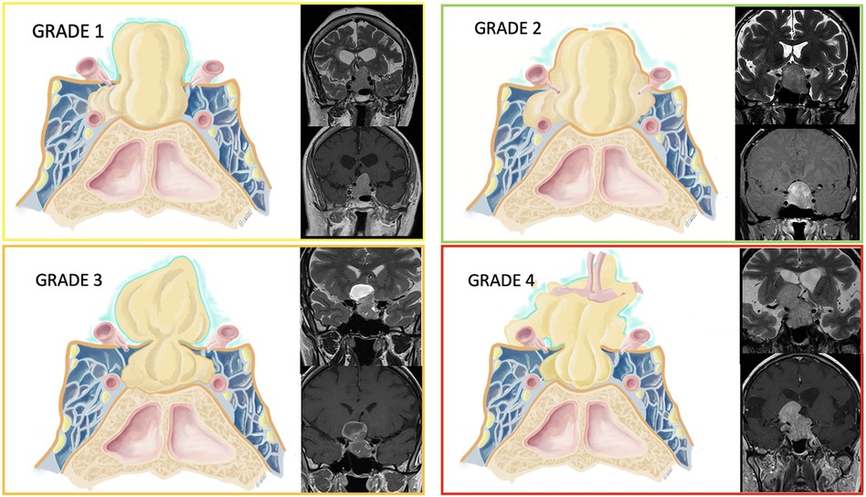 Frontiers  Outcome of giant pituitary tumors requiring surgery