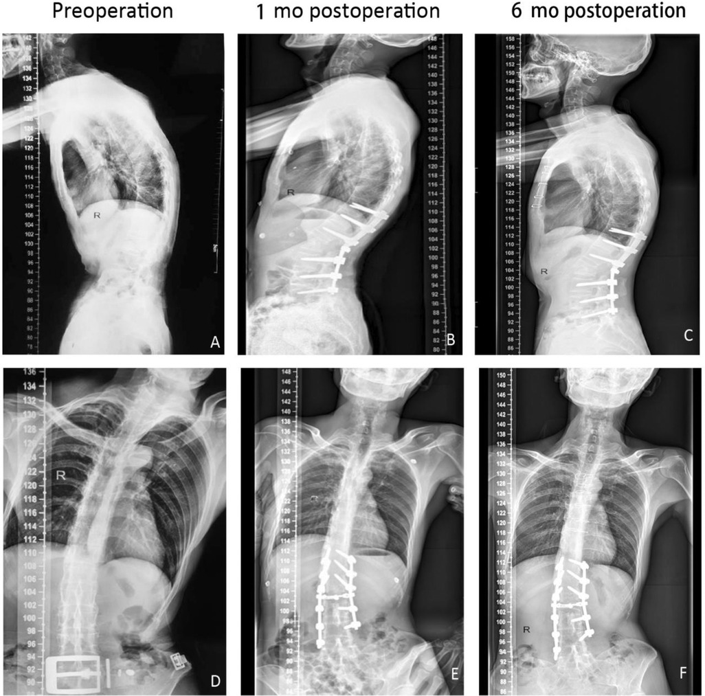 A drawing of a lateral spinal radiograph describing the rib-index