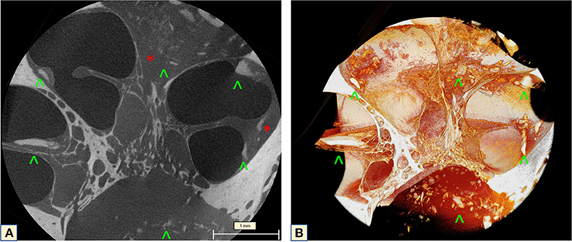 Stapes, Radiology Reference Article