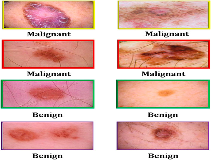 The patient exhibits further signs of basal cell nevus syndrome