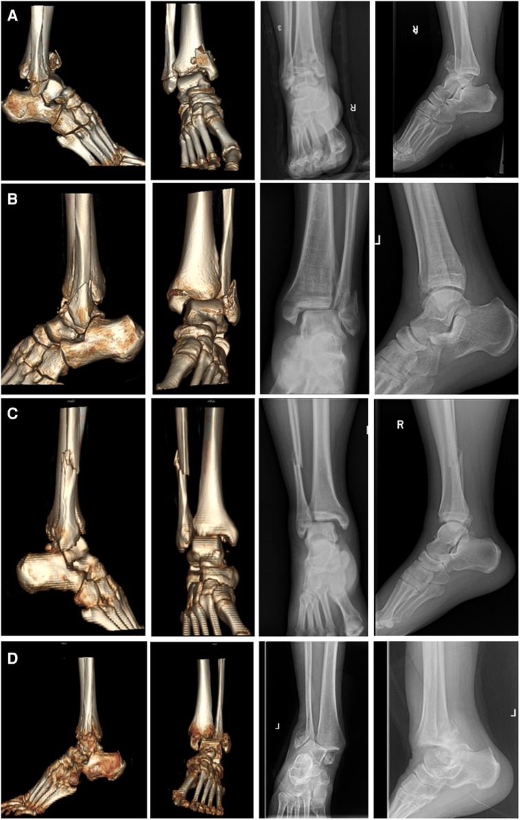 JBJS: The Ligament Anatomy of the Deltoid Complex of the Ankle: A  Qualitative and Quantitative Anatomical Study