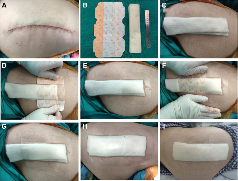 PDF] Dermabond wound closure in primary hip arthroplasty.