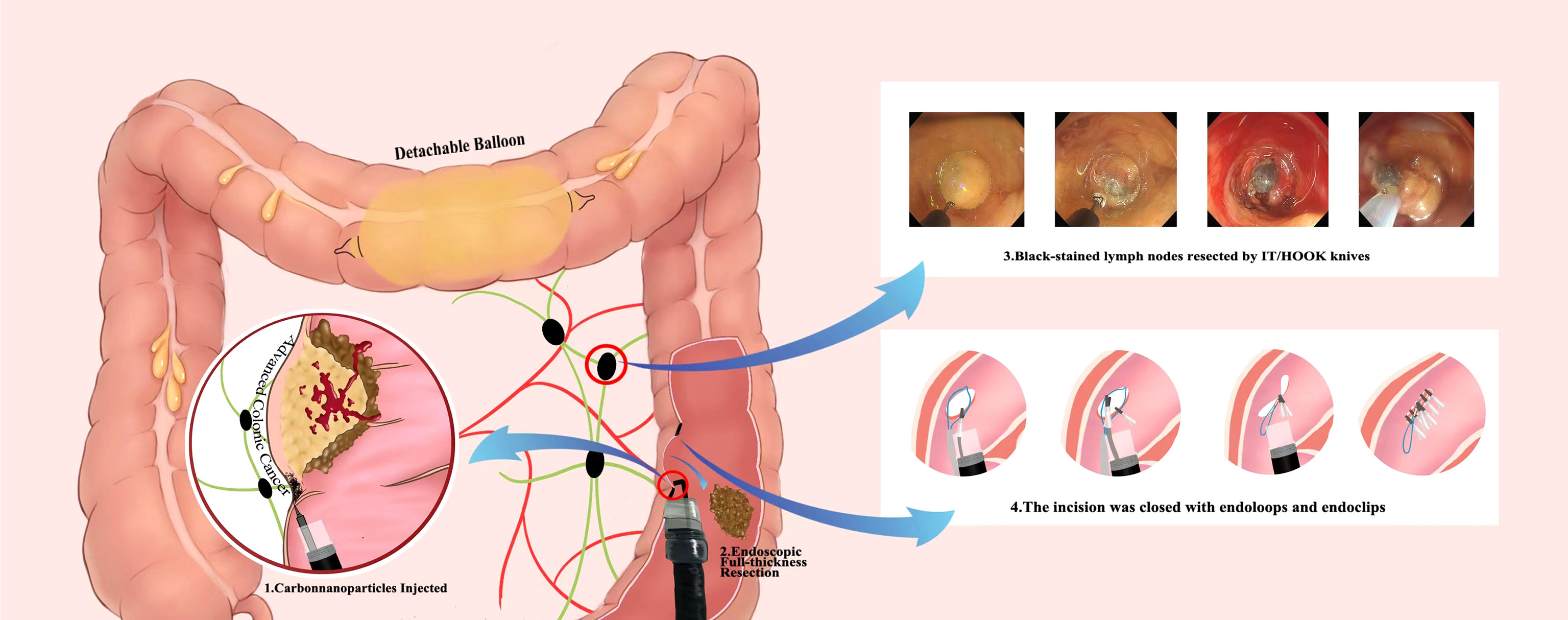 endoscopy for colon cancer