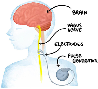 Figure 2 - A VNS device consists of tiny electrodes that are attached to the vagus nerve, which in turn has multiple connections to the brain.