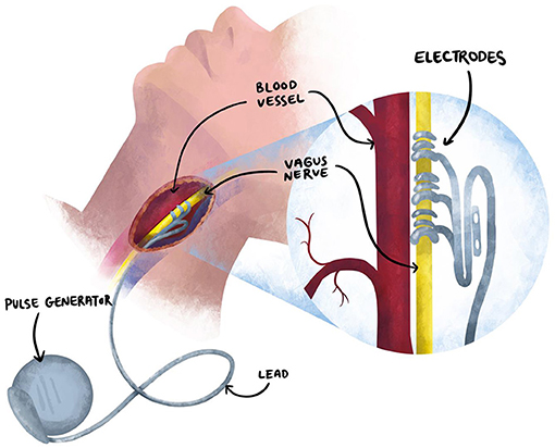Figure 3 - To attach a VNS device, a brain surgeon makes an incision in the skin of the neck to wrap the electrodes of the VNS around the vagus nerve.