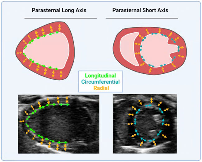 Early Diastolic Longitudinal Strain Rate at MRI and Outcomes in Heart  Failure with Preserved Ejection Fraction