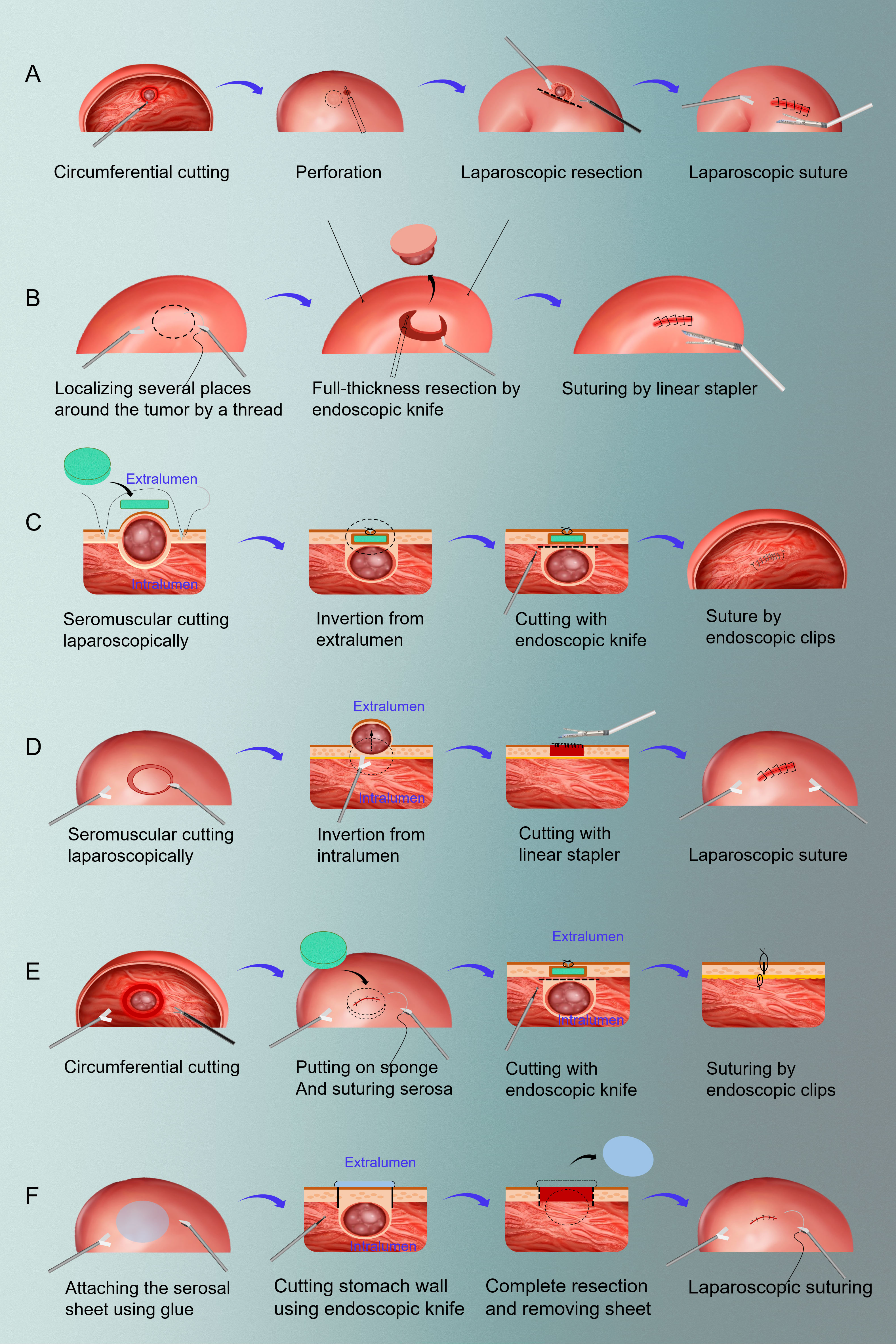 Frontiers Laparoscopic And Endoscopic Cooperative Surgery For Early 