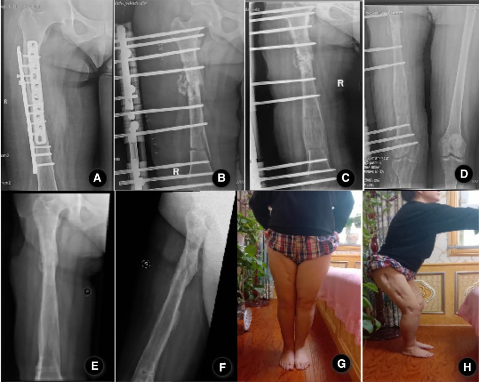 Llizarov Tibia Ring External Fixator Lengthening for Delayed