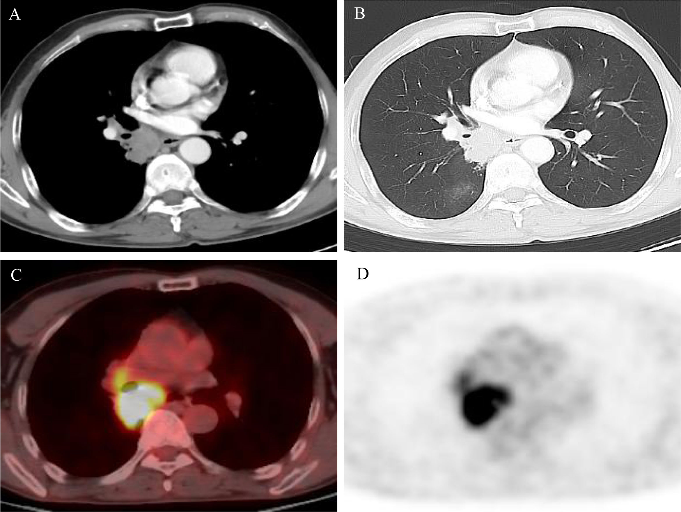 What Is Locally Advanced Lung Cancer What Is Locally Advanced Lung Cancer