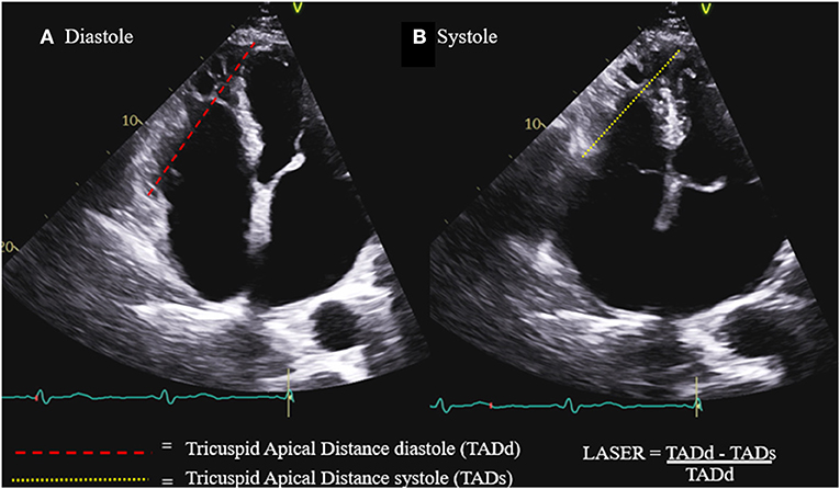 Validation of the Tricuspid Annular Plane Systolic Excursion