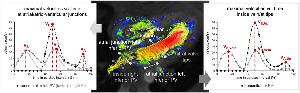 Transmitral inflow velocity patterns, E/A ratio, and mean left