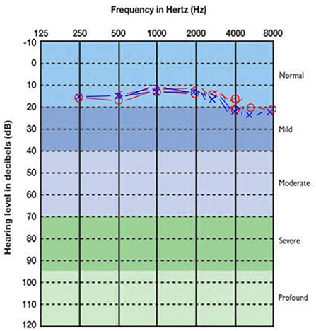 Mild tinnitus in one ear hotsell