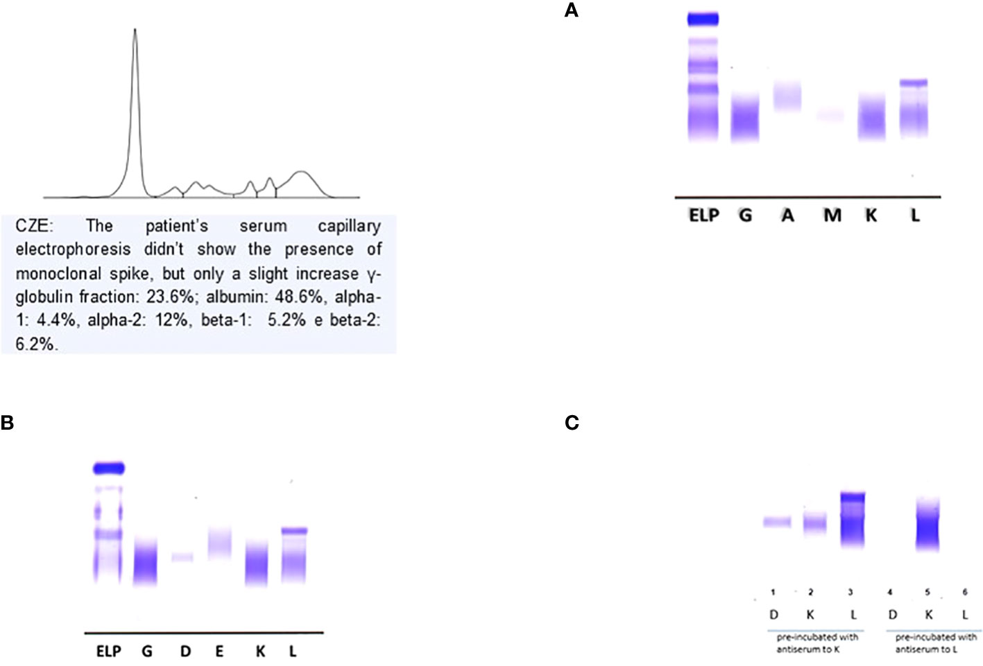 bijzonder Verlichten Weigeren Frontiers | Case Report: A case of IgD lambda/lambda Multiple Myeloma in  patient with acute renal failure and without monoclonal spike in serum  electrophoresis