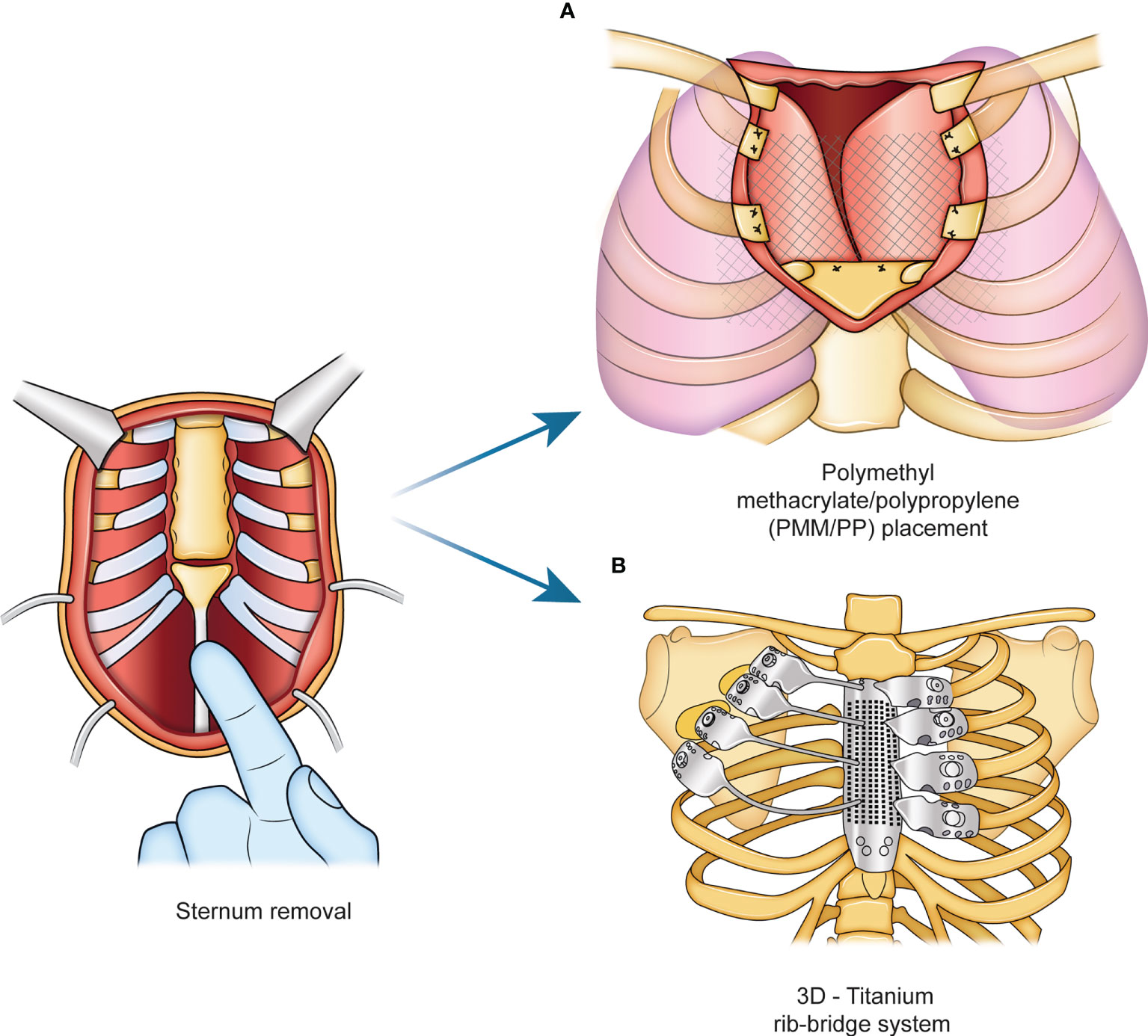 Frontiers  The sternum reconstruction: Present and future perspectives