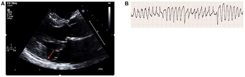 Hypokinesis, Mitral Regurgitation, Aortic Insufficiency 