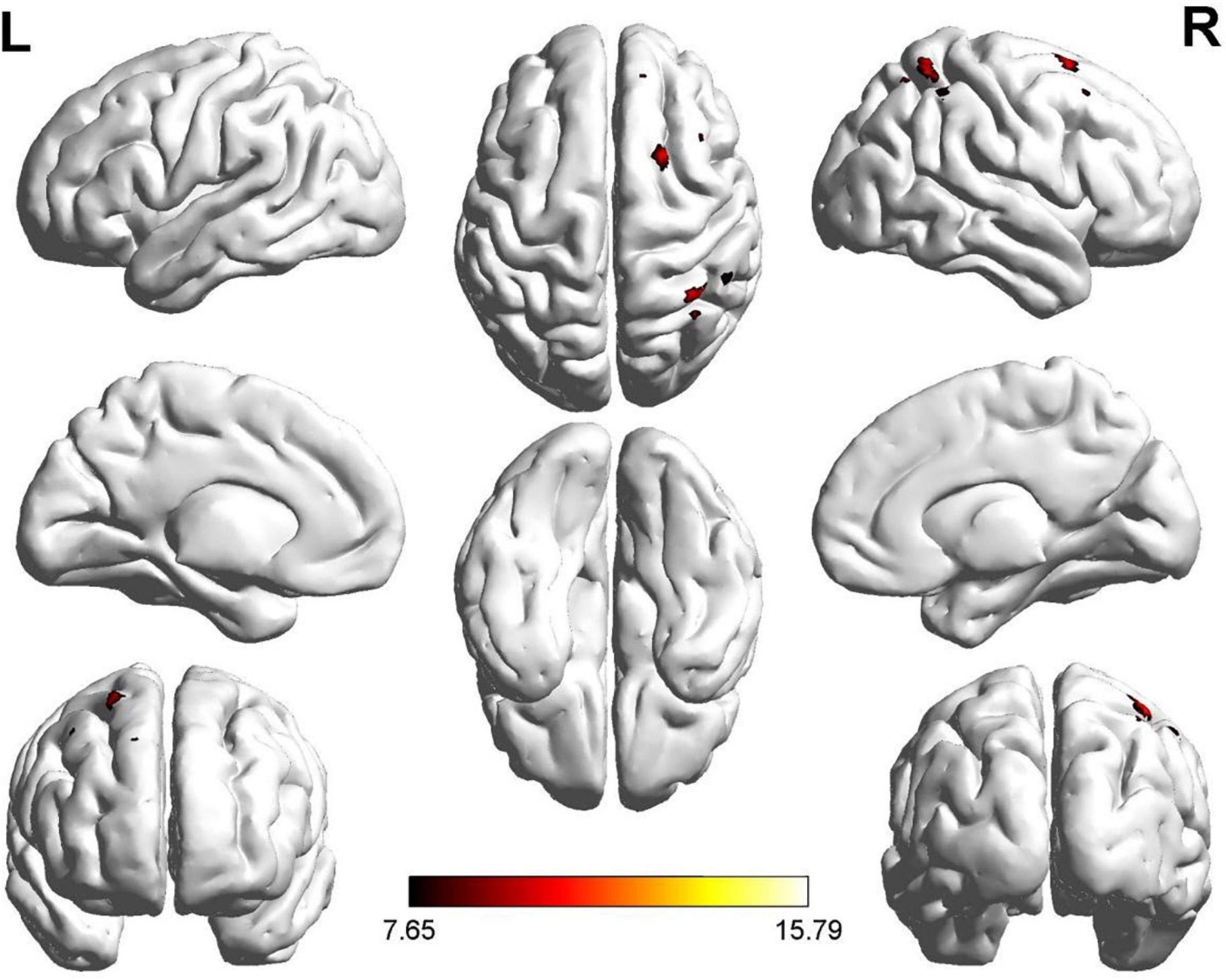Persistent tinnitus hotsell