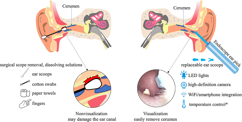 Frontiers | Endoscope ear pick: An emerging but neglected medical device