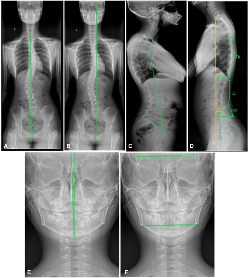 Frontiers  Trunk balance, head posture and plantar pressure in