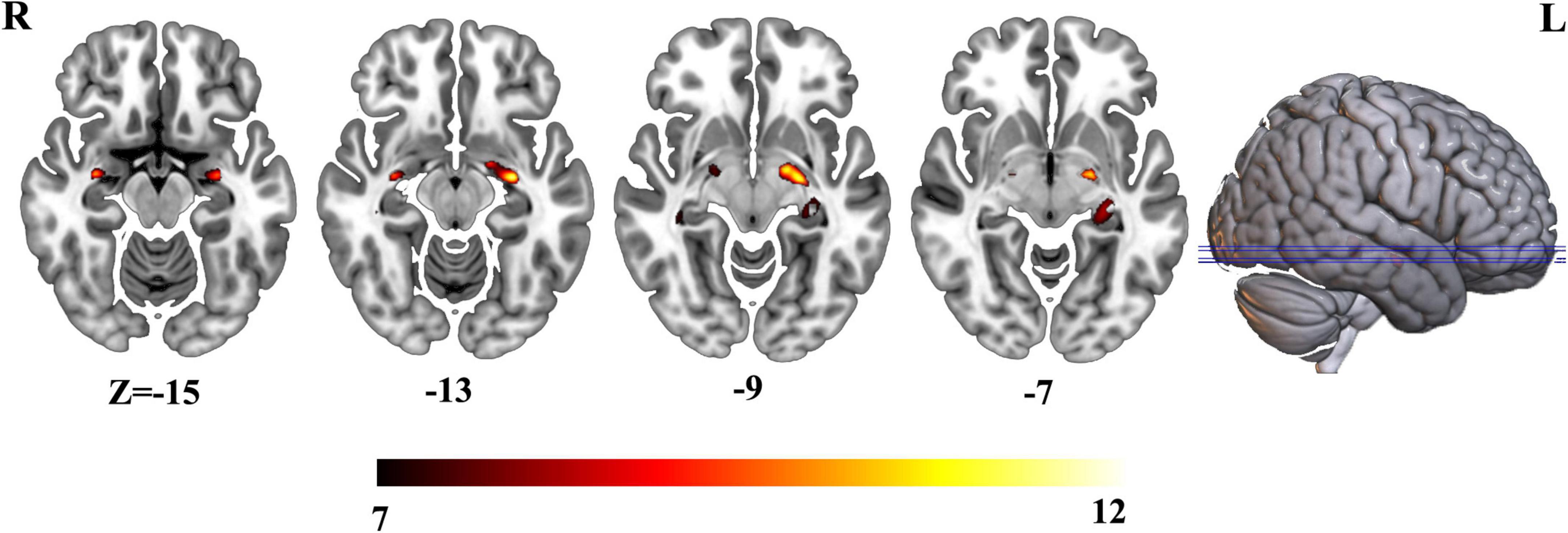 Frontiers Hippocampal morphological atrophy and distinct patterns of structural covariance network in Alzheimers disease and mild cognitive impairment
