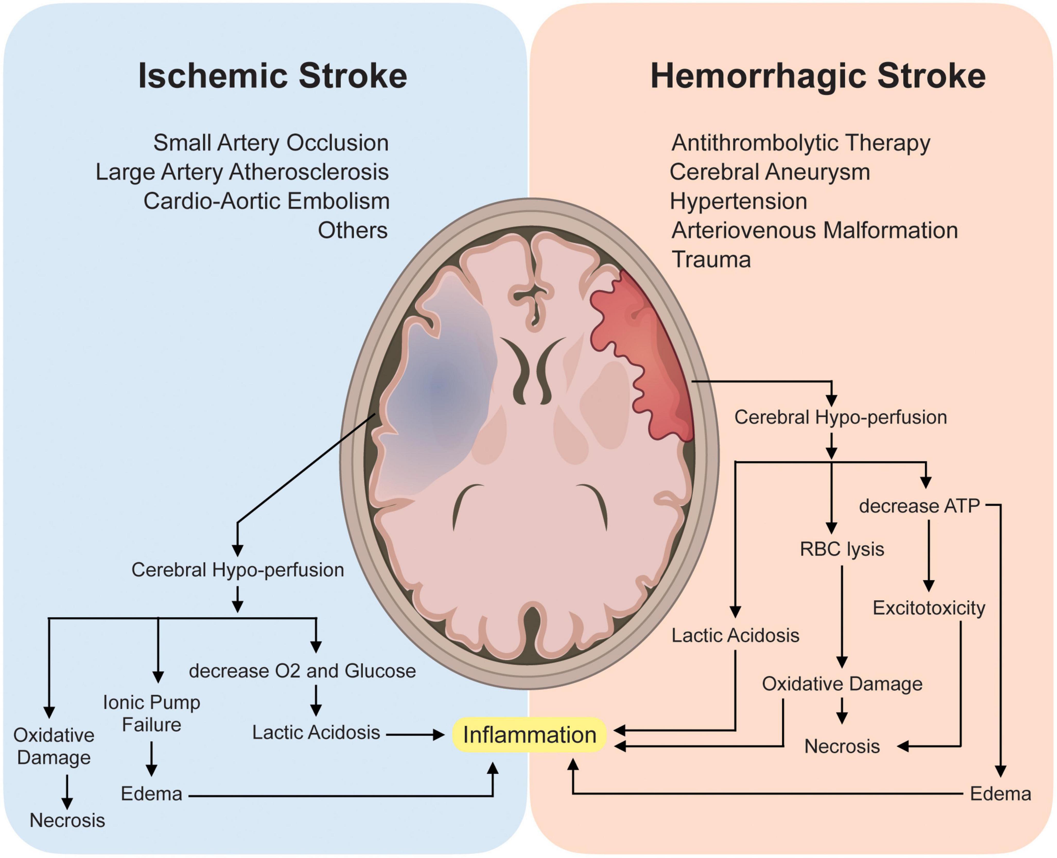 ischemic stroke pathophysiology