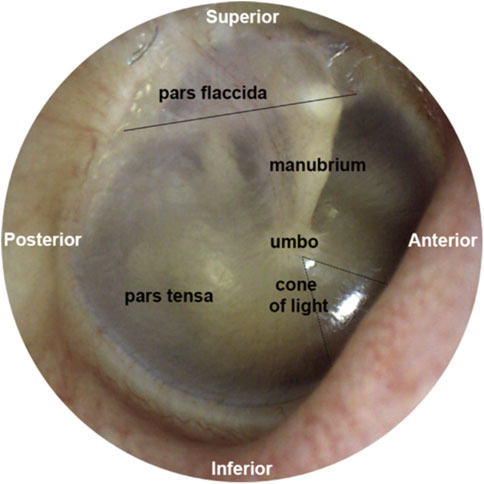 Tympanosclerosis – Oto Surgery Atlas