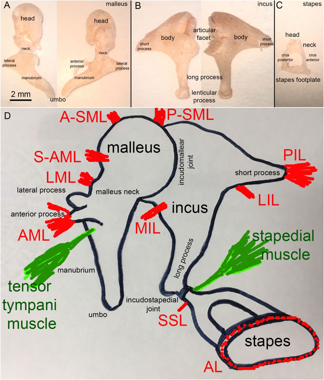 Tympanosclerosis – Oto Surgery Atlas