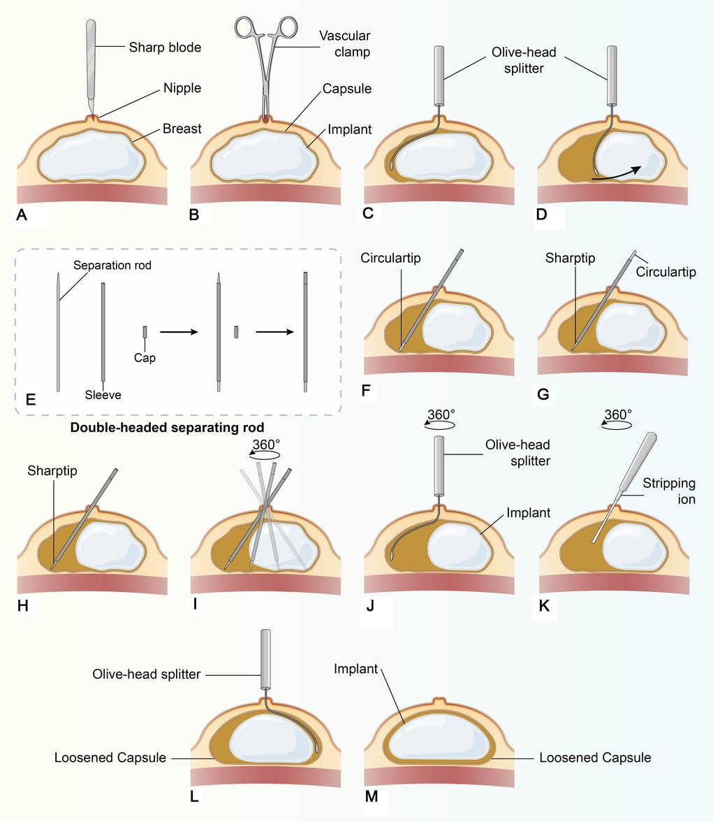 Various types of breast deformities. a Grade I breast contracture