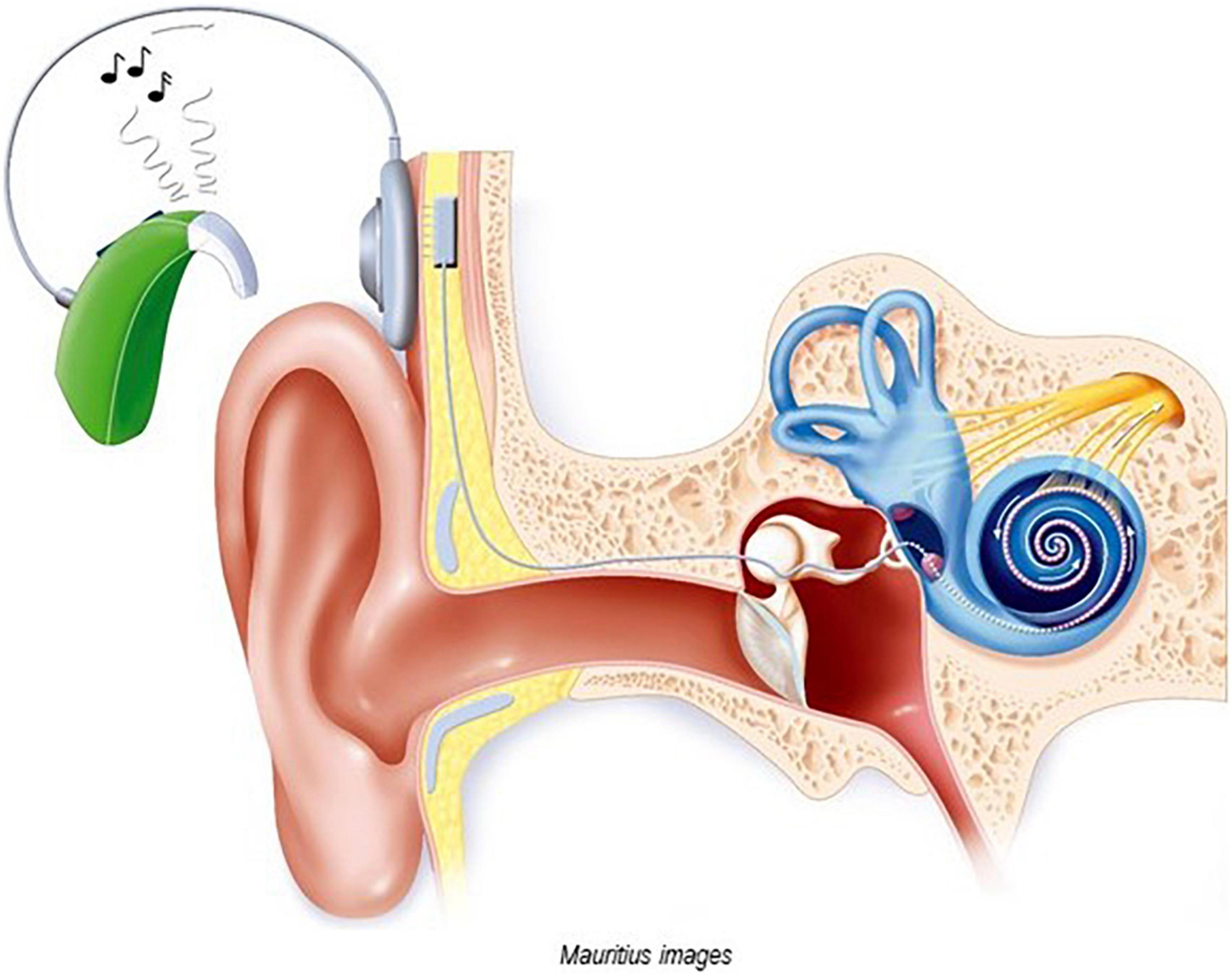 Frontiers Cochlear Implant specific Risks Should Be Considered When 